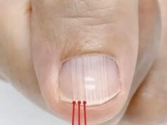 Understanding the Real Causes of Vertical Ridges on Your Nails