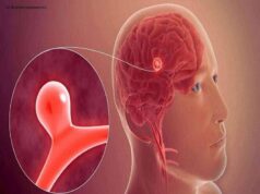 12 signs that may signal a brain aneurysm — Don’t ignore them