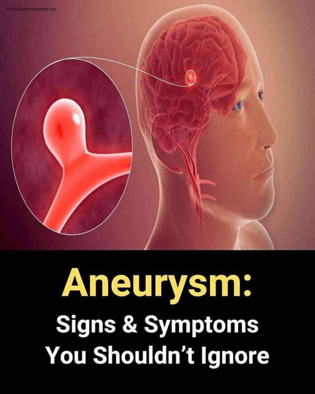 Aneurysm Signs You Shouldn't Ignore.....😳👇see more
