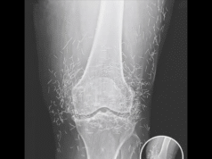 Doctors Shocked by What They Found Hidden Inside a Woman’s Knee X-Ray