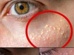 Tiny White Bumps on Your Face? Here’s What They Are—And How to Treat Milia Naturally and Safely at Home