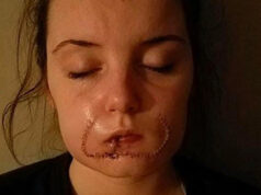 ”My ex bit off my entire lip to ‘leave his mark’ but I’ll never let him break me”