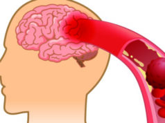 10 signs your arteries might be clogged