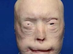 He suffered devastating burns when he tried to rescue a woman trapped in a fire, For years, he was terrified to show his face to the world, and wore caps, sunglasses and prosthetic ears in public