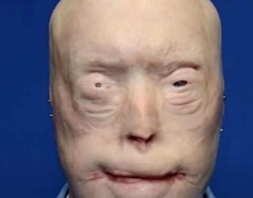 He suffered devastating burns when he tried to rescue a woman trapped in a fire, For years, he was terrified to show his face to the world, and wore caps, sunglasses and prosthetic ears in public