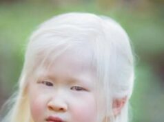A baby girl born with albinism was abandoned by her parents!