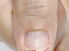 Vertical Nail Ridges: Normal Changes and Nail Health
