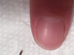 A Simple Guide to Safely Removing an Insect From Your Hair