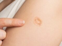 Smallpox vaccine scars: What they look like and why
