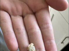 A Simple Guide to Understanding Tonsil Stones