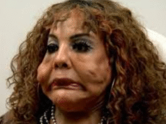 Injected with Cement! Her Unbelievable Transformation 14 Years Later!