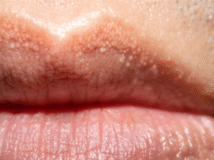 Reason behind strange white bumps found on your private parts