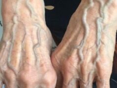 When to Worry About Veins That Appear Out of Nowhere!?
