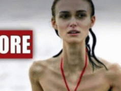 Their acne is severe!