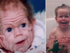 Tomm Tennent was born with enough skin for a five-year-old child