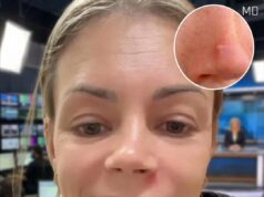 Doctors Share Important Advice About Popping Pimples in Sensitive Areas of the Face