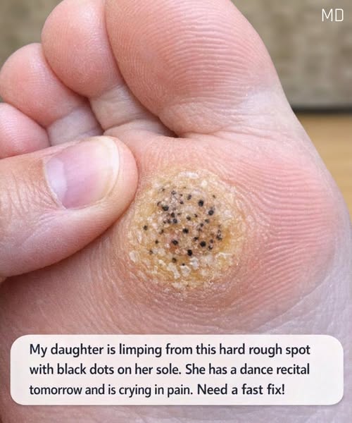 My daughter is limping from this hard rough spot with black dots on her sole. She has a dance recital tomorrow and is crying in pain. Need a fast fix!. Full article 👇 💬