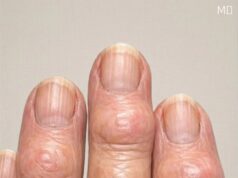 My grandma has these hard bumps forming on her finger joints near the nails. Why is this spreading?