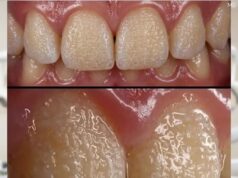 Can Rice Help Improve the Appearance of Teeth? Exploring a Popular Home Method