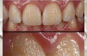 Can Rice Help Improve the Appearance of Teeth? Exploring a Popular Home Method