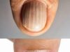 Why You Should Never Ignore These Mysterious Lines On Your Nails Because They Might Be Your Bodys Final Warning About A Serious Hidden Health Condition