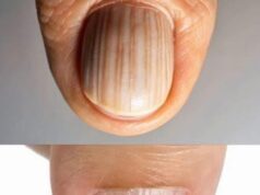 Why You Should Never Ignore These Mysterious Lines On Your Nails Because They Might Be Your Bodys Final Warning About A Serious Hidden Health Condition