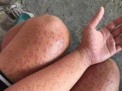 The Hidden Killer In Your Bed Why Waking Up With These Itchy Red Patches Is A High Stakes Medical Emergency That Could Shut Down Your Ability To Breathe In Minutes