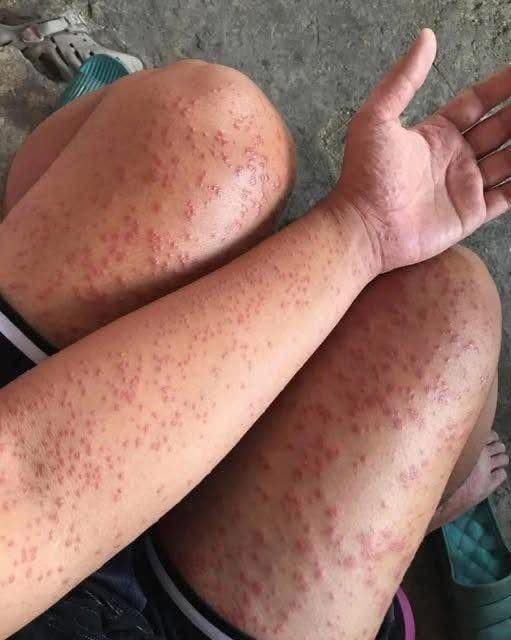 I slept at my friends old apartment for a couple days and noticed these weird bumps WHAT