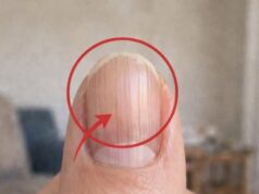 Doctor Uncovers A Telltale Sign In Your Fingernails That May Predict Your Life Expectancy