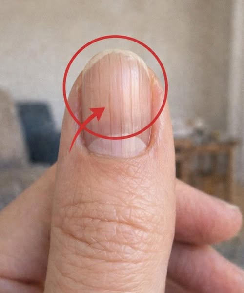 If you have lines on your nails, it means you have ca...See more