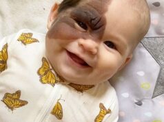 A Mother’s Love: Vienna’s Journey with a Birthmark