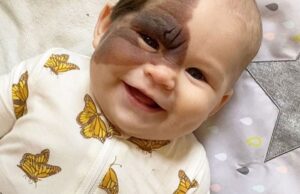 A Mother’s Love: Vienna’s Journey with a Birthmark