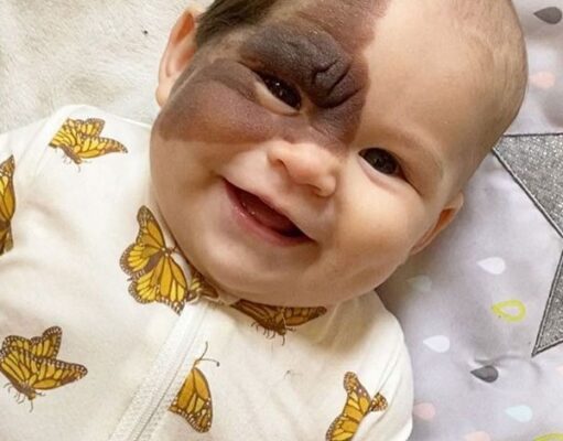 A Mother’s Love: Vienna’s Journey with a Birthmark